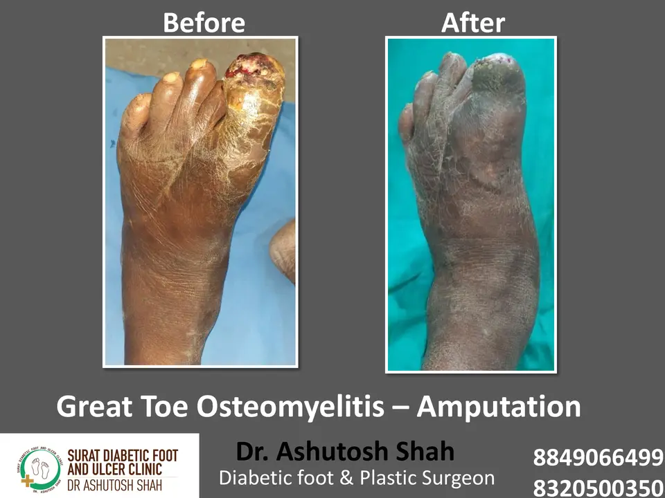 Diabetic Foot  PPT sunita.pptx-39.webp